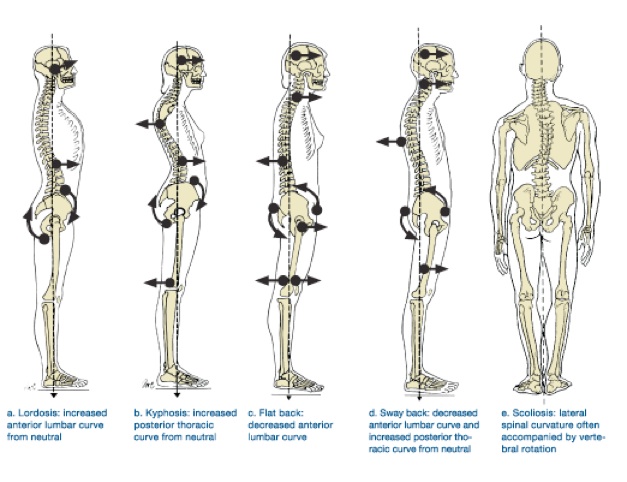 A) Normal posture. (B) Slouched posture. (C) Upright posture